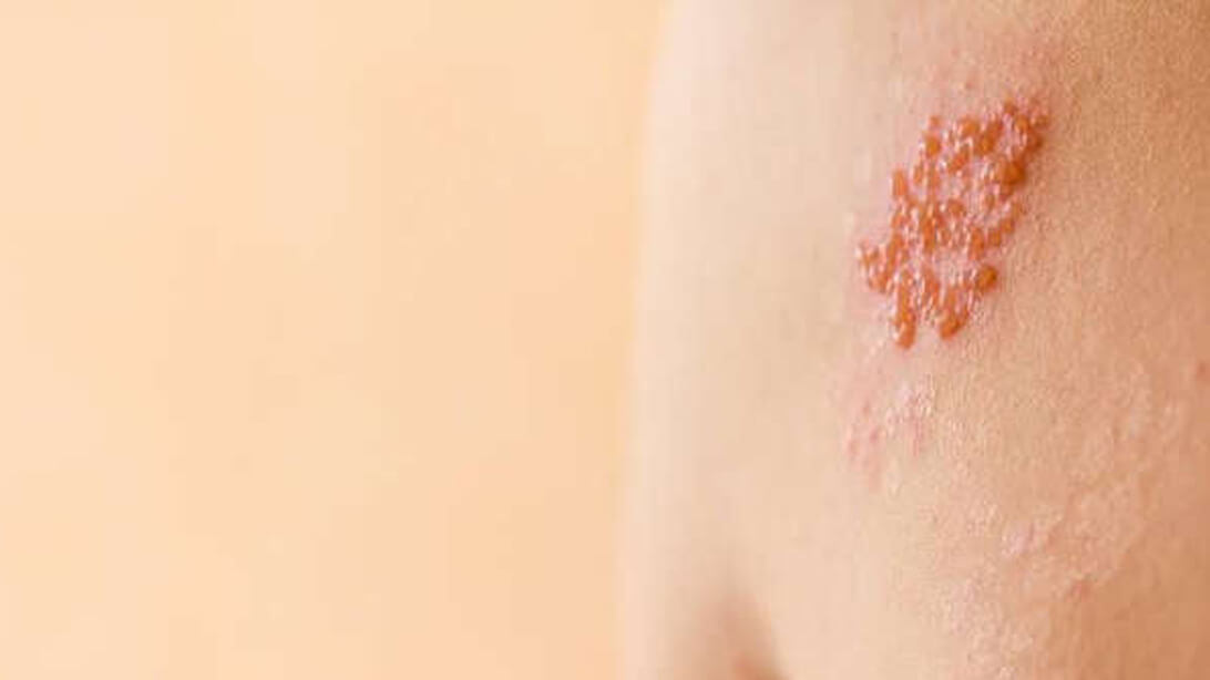Herpes zoster