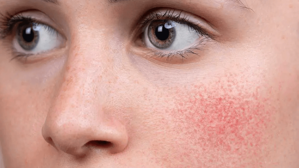 Las 10 mejores cremas de farmacia para la piel con rosácea
