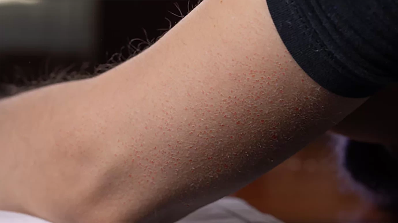 Queratosis Pilaris