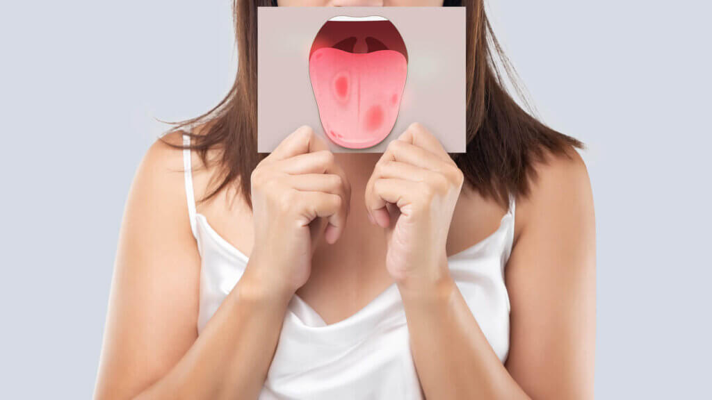 la Candidiasis oral